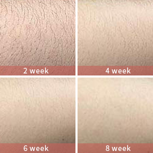 laser hair removal 5