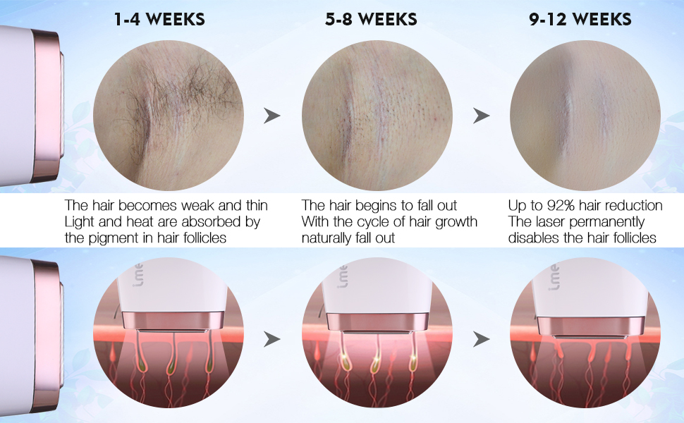 How often to use laser hair removal