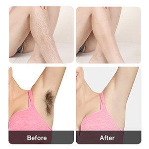 hair removal devices for women
