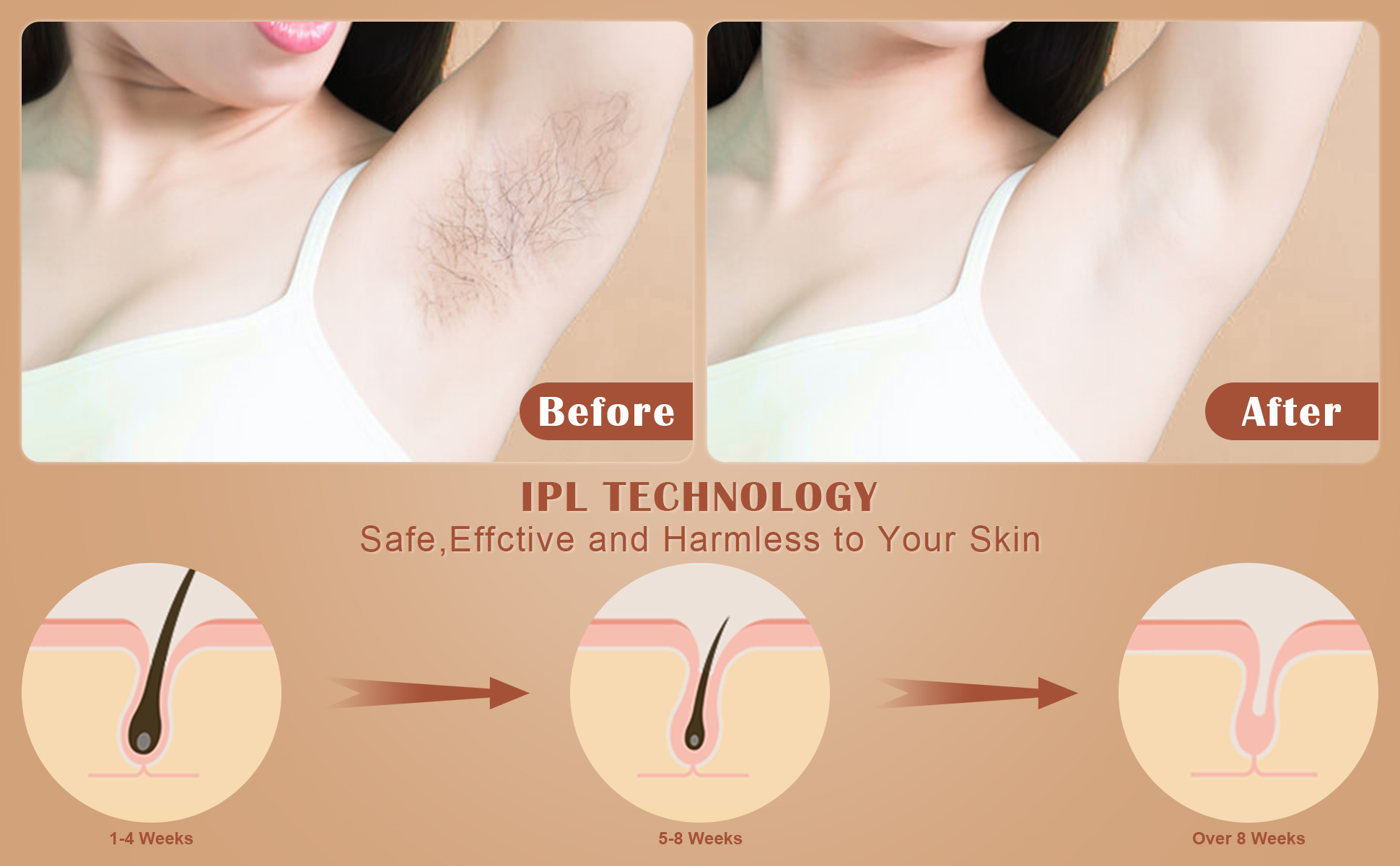 ipl laser hair removal women